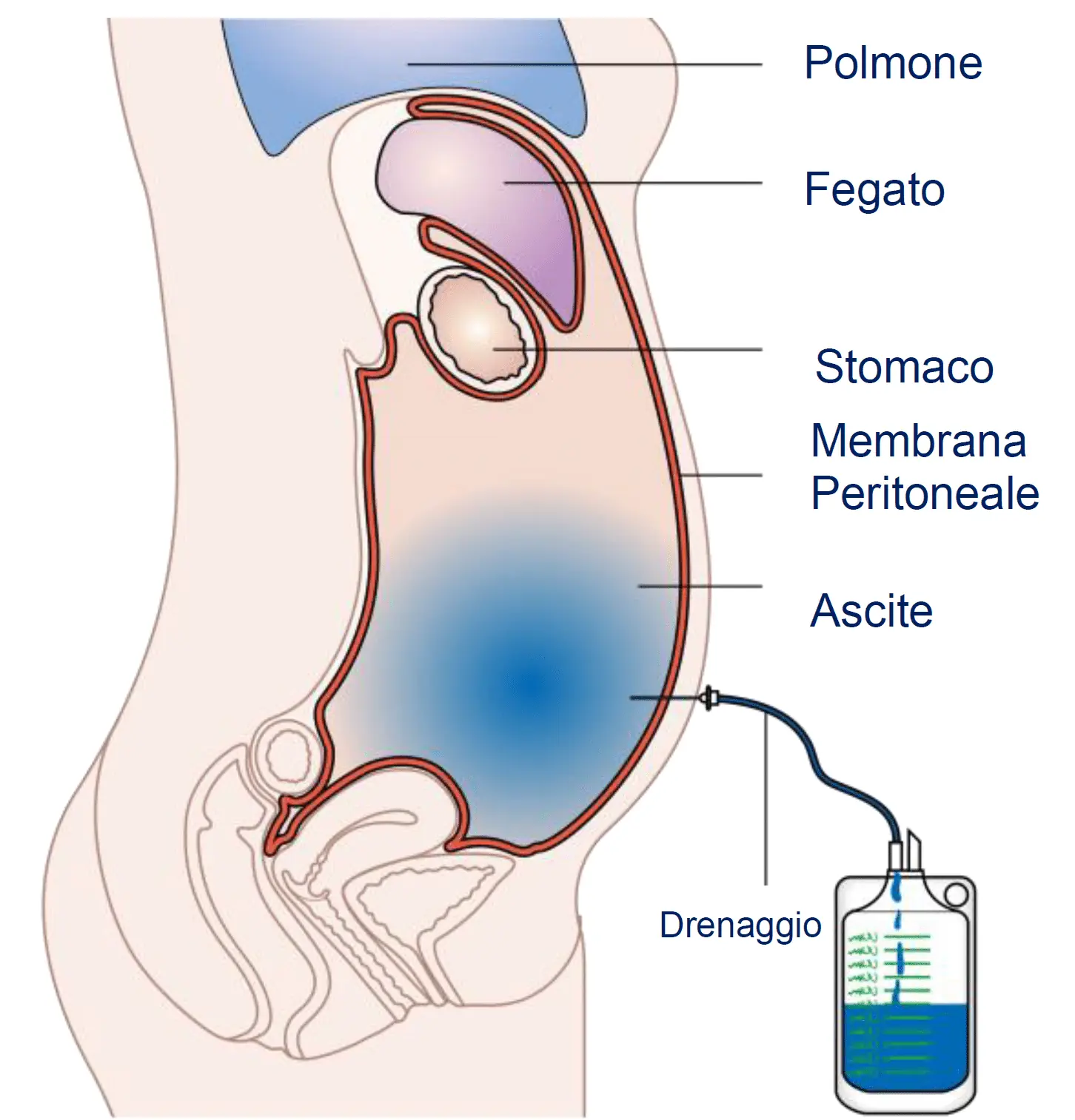 Ecografia e materiale sterile utilizzati per una paracentesi evacuativa domiciliare